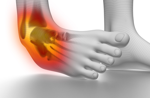 ankle_sprain.jpg